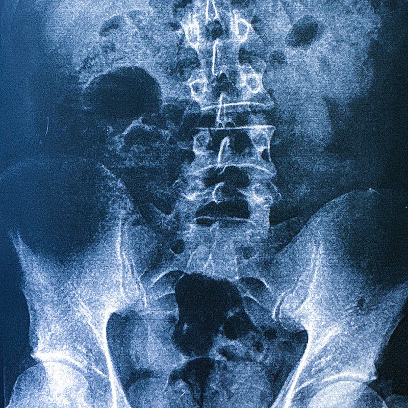 Mesa founder Joshua Kasumovic’s hip X-ray showing a 10mm leg length discrepancy (LLD) with the resulting pelvic misalignment and lumbar scoliosis.